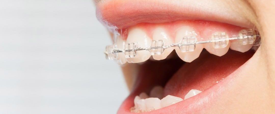 brackets-zafiro-tratamientos-clinica-dental-ignacio-espona-brackets-granada brackets-zafiro-tratamientos-clinica-dental-ignacio-espona-brackets-granada