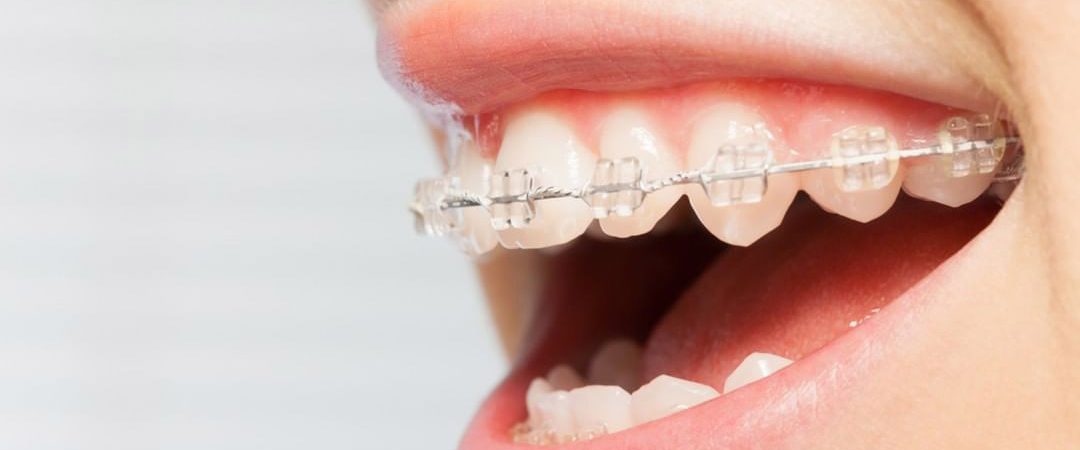 brackets-zafiro-tratamientos-clinica-dental-ignacio-espona-brackets-granada