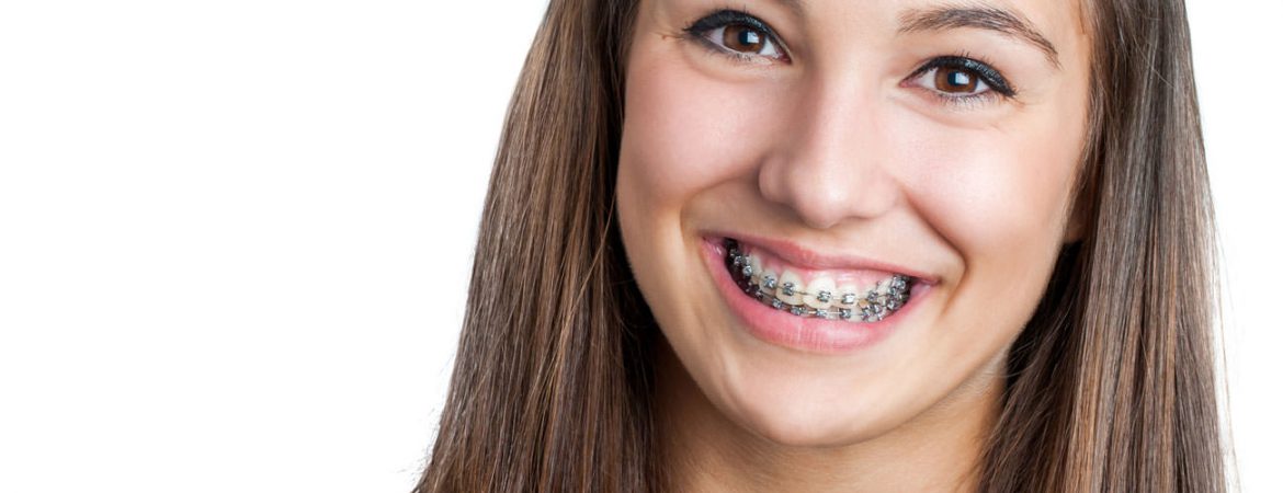 ortodoncia-adultos-tratamientos-clinica-dental-ignacio-espona-brackets-granada