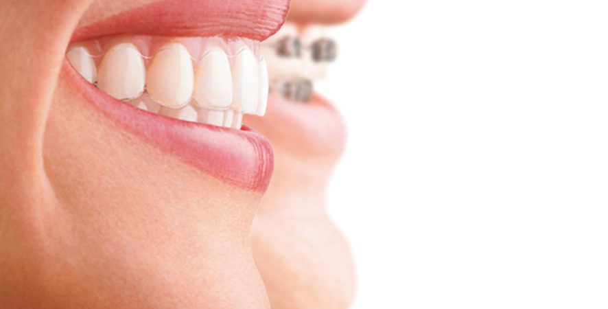ortodoncia-maloclusiones-tratamientos-clinica-dental-ignacio-espona-brackets-granada